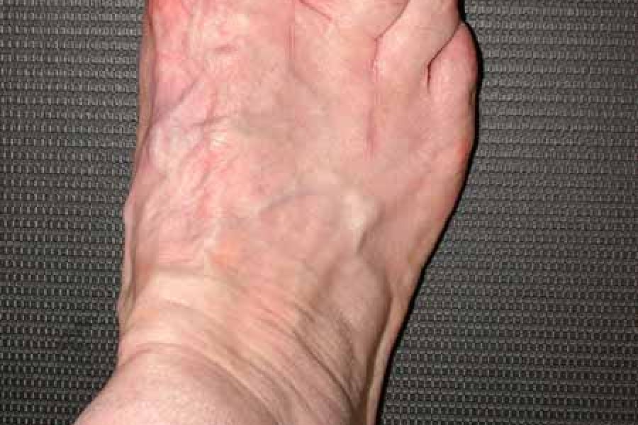 6 Monate nach Scarf-Osteotomie und Weil-Osteotomie der Zehen 2-4 ist der Fuss nicht nur schöner, sondern auch schmerzfrei. Wanderungen von bis 5 Stunden sind ohne Schmerzen möglich.